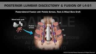 Posterior Lumbar Discectomy amp Fusion of L4S1 [upl. by Light]