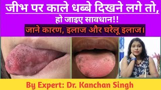 जीभ पे काले धब्बे का घरेलू इलाज black spot on tongue how to remove Dr Kanchan Singh [upl. by Hepsiba]