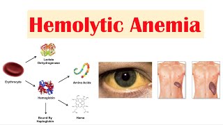 Hemolytic Anemia [upl. by Vano]