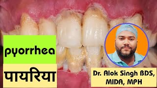 Pyorrhea  पायरिया  क्यों होता है पायरिया क्या इलाज होता है इसमें  dentalcare pyorrhea [upl. by Huntlee670]