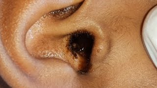 ASMR  EAR WAX CLEANING WITH QTIPS [upl. by Weld]