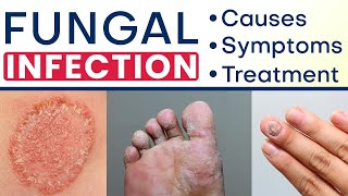 ✅ Fungal Infection क्या और कैसे होता है ✅ Fungal Infection Symptoms Causes and Treatment in Hindi [upl. by Anehta397]