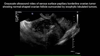 UOGJournal clip on ultrasonographic features of serous surface papillary borderline ovarian tumour [upl. by Chien]