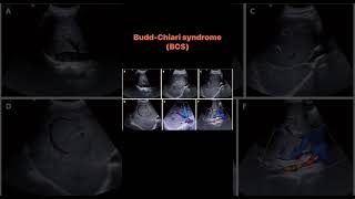 BuddChiari syndrome BCS [upl. by Imekawulo]