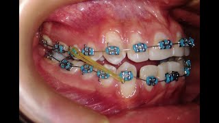 Elásticos Intermaxilares  Mira como ayudan en tu tratamiento con brackets☝ [upl. by Nolyar379]