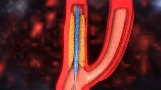 Carotid Artery Stenting video [upl. by Olgnaed]