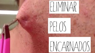 Cómo hacer para Eliminar pelos encarnados [upl. by Eikkin]