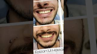 Braces Transformation Nice And Easy😁from flat to consonant and add bonus of the diastema closure [upl. by Droffats]