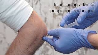 Injection Technique for Lateral Epicondylalgia [upl. by Zurek625]