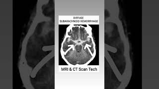 Subarachnoid Hemorrhage CT Scan viral youtubeshorts ct shortsfeed [upl. by Yahs]