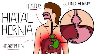 Hiatal Hernia Explained Hiatus Hernia [upl. by Aura]