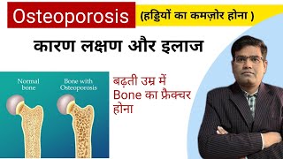 Osteoporosis Causes Symptoms Tests and Treatment in Hindi  बढ़ती उम्र के साथ Bones का कमजोर होना [upl. by Dnalloh]