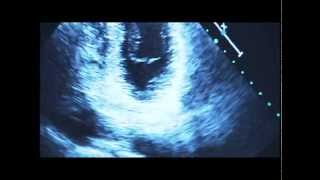 Living with Mitral Valve Prolapse [upl. by Adihahs672]