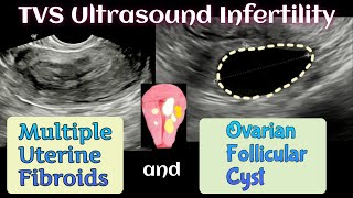 15 th Day TVS Ultrasound  Follicular Cyst  Multiple Uterine Fibroids  Infertility [upl. by Alys11]