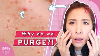 Which Products Cause Skin Purging 🌋 Tips for All Skin Types [upl. by Ahseal205]