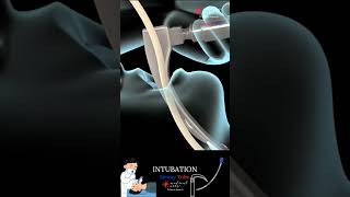 Intubation  EndoTracheal Tube  Breathing Tube medicalanimation [upl. by Melc]