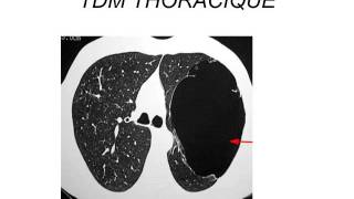 PNEUMOLOGIE broncho pneumopathie chronique obstructive 2015 [upl. by Vasos101]