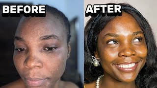 How i cleared my skin with just 3 products  in 1 month [upl. by Yhcir]