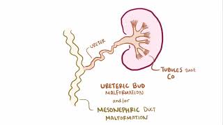 Multi cystic dysplastic Kidney  Renal pathology  Osmosis [upl. by Miner]