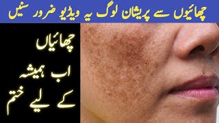 Get Rid Of Melasma Why Melasma is not treated  Pigmentation Treatment [upl. by Magavern969]