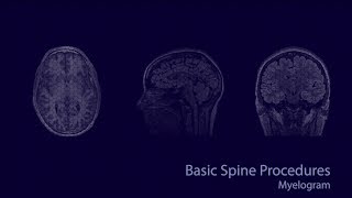 Basic neuroradiology procedures part 3  Myelogram [upl. by Homere]