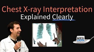 Atelectasis Rapid Review of Chest Xrays [upl. by Reppep64]