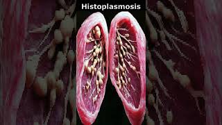 ğŸ¦ HistoplasmosisğŸŒ¡ï¸ [upl. by Ias]