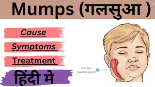 MUMPS गलसुआ  क्या हैँ  Cause  Signs amp Symptoms  Treatment  Hindi  Urbancity HealthCare [upl. by Viscardi]