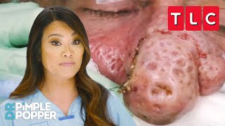 Bumpiest Nose Growths  Dr Pimple Popper  TLC [upl. by Heringer]