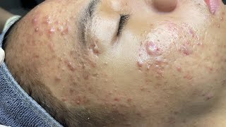 ACNE TREATMENT VU QUYNH MI Blackheads On Boy Face 2024 [upl. by Matusow]