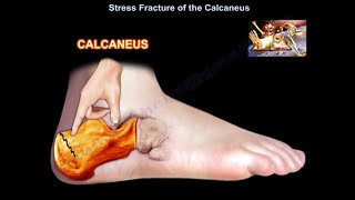 Stress Fracture of the Calcaneus  Everything You Need To Know  Dr Nabil Ebraheim [upl. by Ahsimac34]