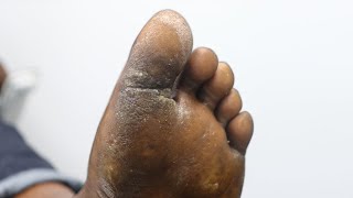 Crusty Foot callus with lot of wounds  Removal of dead skin and scrape callus so satisfying [upl. by Yrevi]