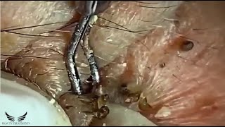 Elderly Hidden Blackhead Removal  Cystic Acne Treatment  Pimple Popping Spa  Acne on Face  079 [upl. by Fortunna935]