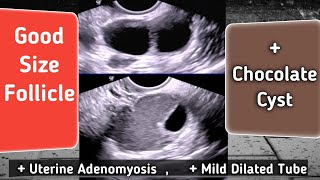 Good Size Ovarian Follicles  TVS Ultrasound  Chocolate Cyst [upl. by Blanka]