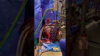 Perfusion aspects by a clinical Perfusionist perfusion nurse [upl. by Elidad826]