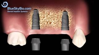 Patient Treatment Videos Implant Bridge [upl. by Calva]