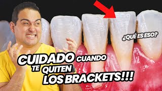 LO QUE NADIE TE DICE SOBRE EL RETIRO DE TUS BRACKETS  CUIDADO CUANDO TE QUITEN LA ORTODONCIA 😑 [upl. by Nalor387]