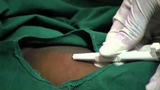 Contraceptive Implants  11  Procedure Insert implant [upl. by Salmon]