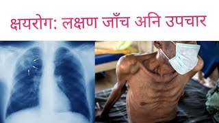 Pneumonia in Nepali निमोनिया बारे जानकारीDr Bhupendra Shahdoctor sathi [upl. by Jocelyne399]