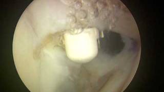 Shoulder Arthroscopy Dr Cascio Biceps tenodesis 2 of 2 [upl. by Elyssa]