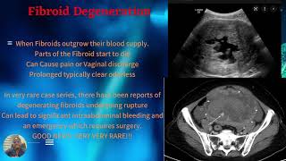 Can fibroids rupture What is Fibroid Degeneration [upl. by Htebarual370]