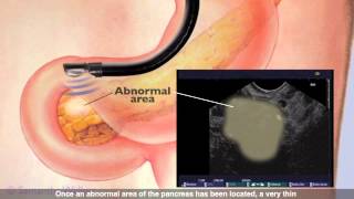 Endoscopic Ultrasound [upl. by Ecirp]