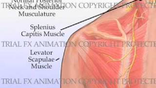 Trigger Point Injections [upl. by Halueb]