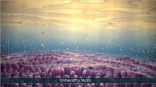 Patient Educational ResourceEffect of Hyperosmolarity on the Ocular Surface and Visual Acuity [upl. by Manville]