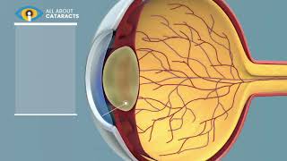 What is a Cataract  Cataract surgery video [upl. by Sej]