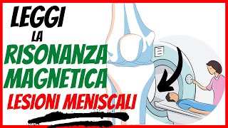 Risonanza magnetica come LEGGERLA  Le LESIONI MENISCALI  Episodio 4 [upl. by Anahpos]