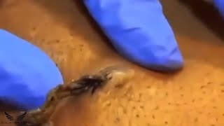 Severe Elderly Blackhead Removal  Cystic Acne Whitehead Treatment  Spa Relaxing Facial Acne  141 [upl. by Garrot]