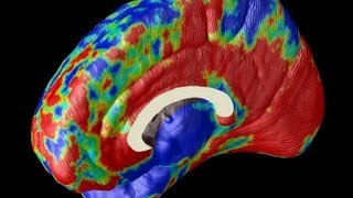 Imaging Alzheimers in the Brain [upl. by Stanly]