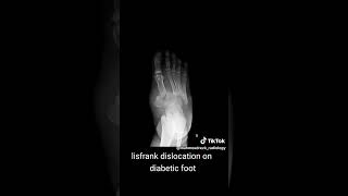 radiology التشخيصالطبي medicalconsultation radiologylife diabetic foot dislocation [upl. by Aneeled652]