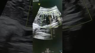 IUFD🥺😭😭  Intrauterine Fetal Death ultrasound shorts videoshorts [upl. by Einuj787]